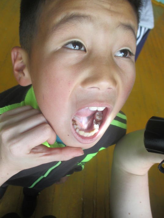 For example, you can see 2 large cavities in both of the bottom quadrants in this kid